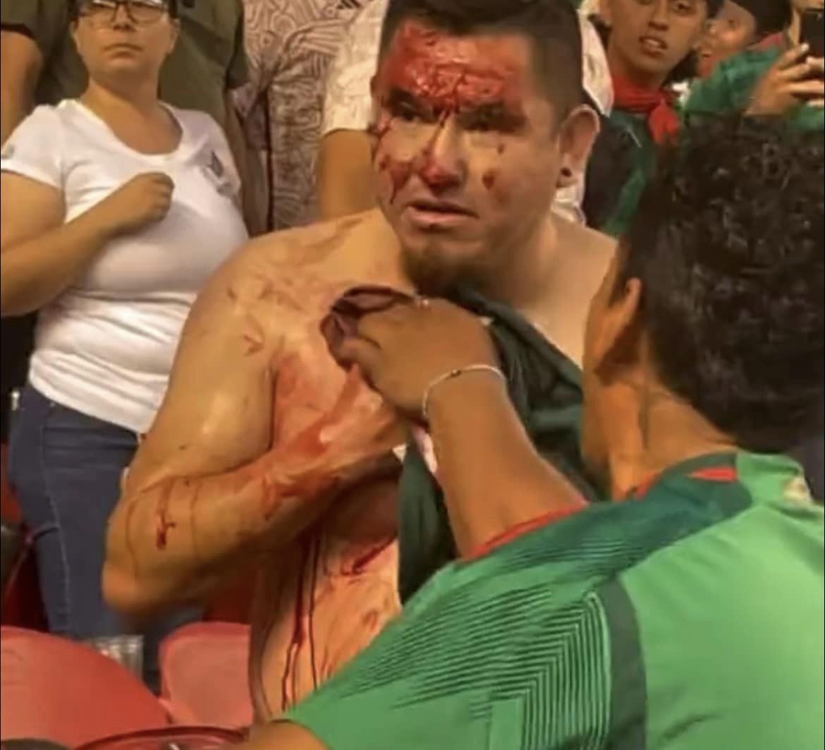 Herido durante el partido de futbol México vs Qatar