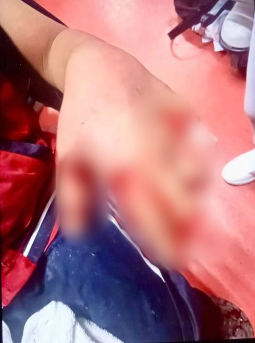 Adolescente Pierde Extremidades por Explosión de Pirotecnia